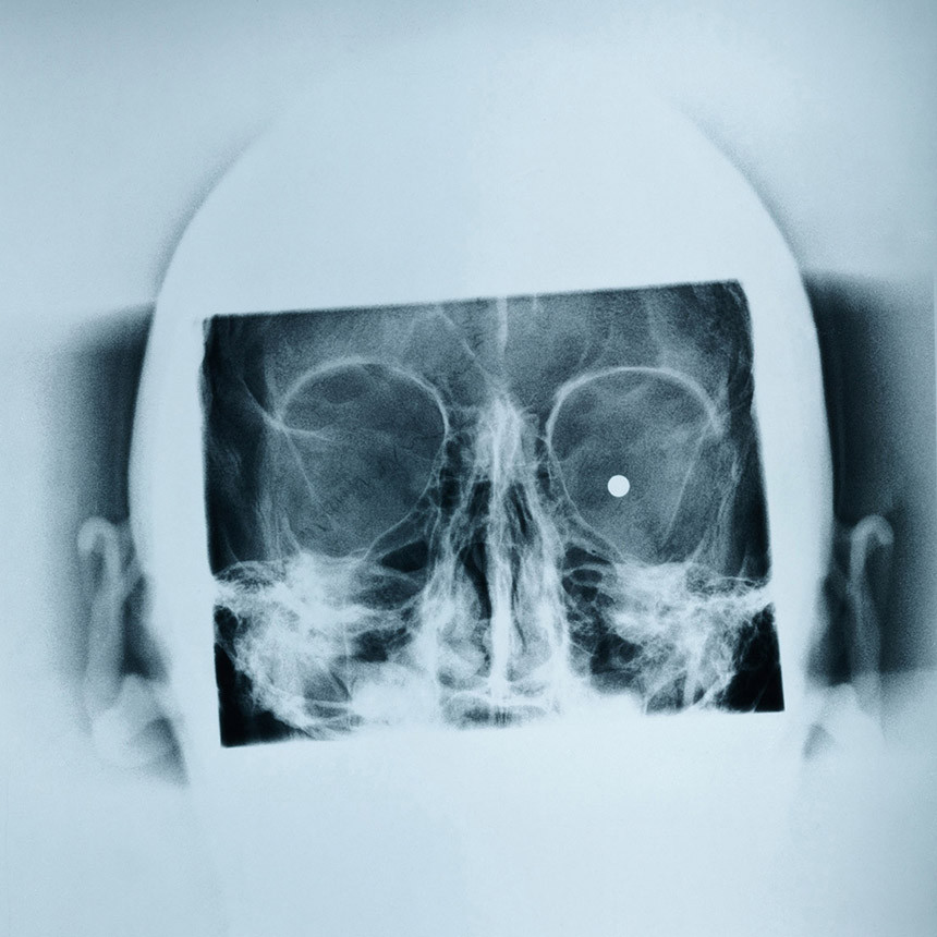 Royal Victoria Hospital, Röntgenabteilung, Röntgenaufnahme einer Schussverletzung